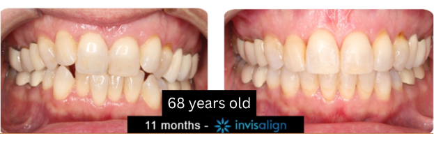 68-year-old patient before and after 11 months of Invisalign treatment at Center for Orthodontics
