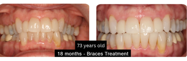 73-year-old patient before and after 18 months of braces treatment at Center for Orthodontics