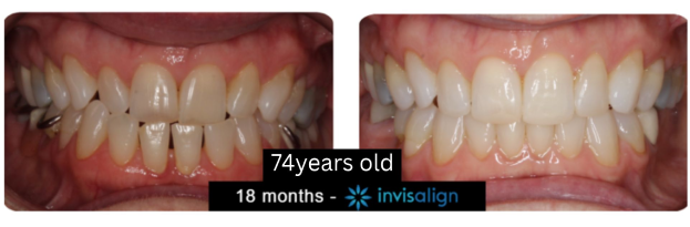 74-year-old patient before and after 18 months of Invisalign treatment at Center for Orthodontics