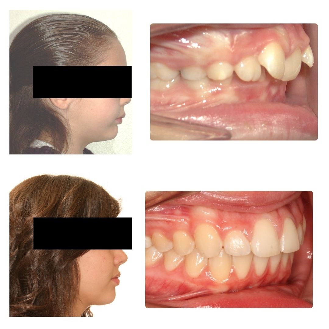 Before & After Case - 1