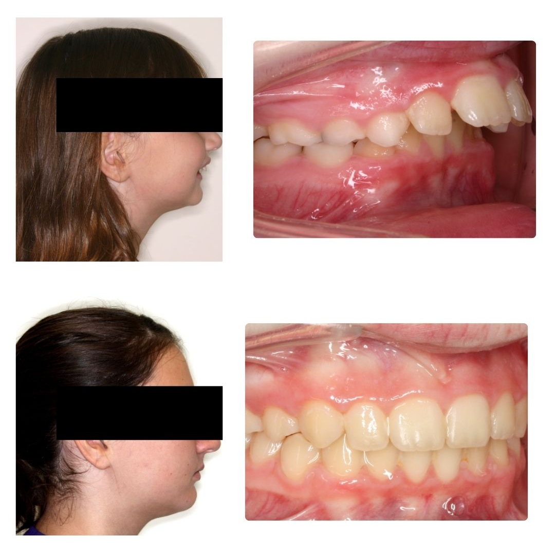 Before & After Case - 2