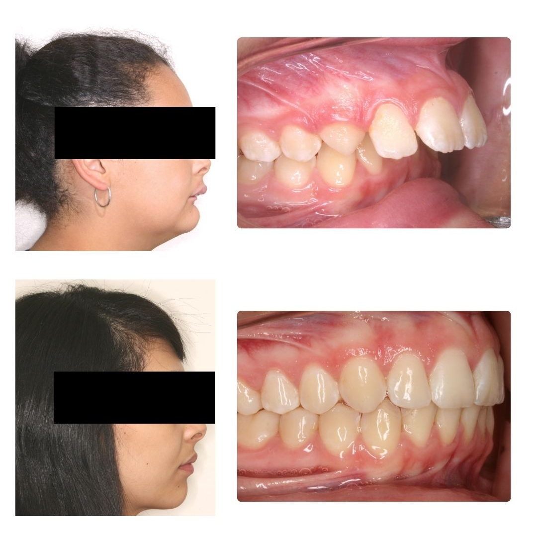 Before & After Case - 3
