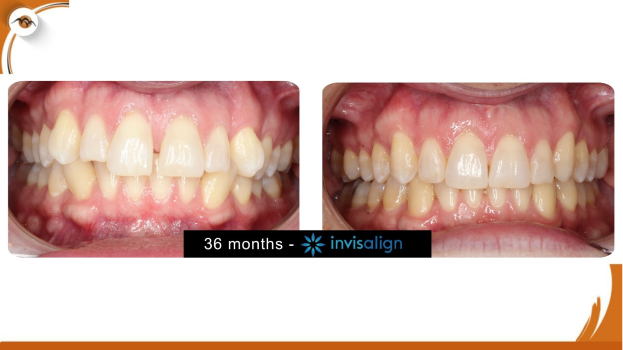 Before and after Invisalign treatment showing improved tooth alignment
