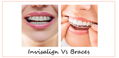 Invisalign Vs Braces: Which One Should You Choose? - Center for