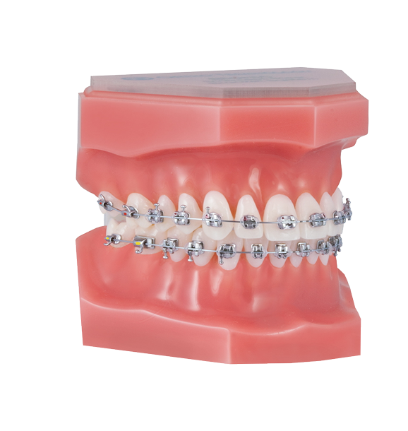 Braces: Types & How They Work